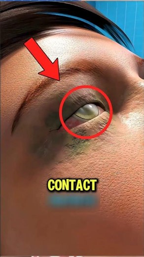 What Happens If You Sleep With Contact Lenses? 😳👁️