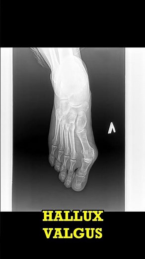Hallux Valgus Spot it on X-ray! (Short)