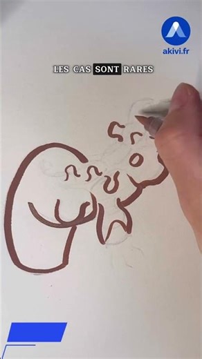 Diverticulite : définition et symptômes