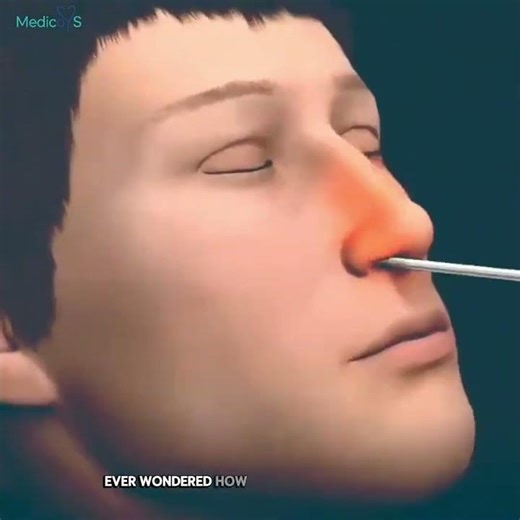 Is Balloon Sinuplasty REALLY Worth It For Chronic Sinus Issues?