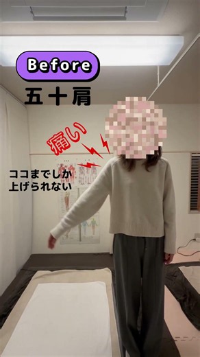 五十肩の症状の改善です『痛みがなくなった！腕が上がる！😆』