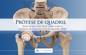 PROTESE DE QUADRIL: Guia Completo sobre a cirurgia de artroplastia de quadril (2021) | Blog | Dr. Daniel Rebolledo