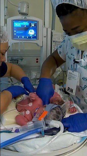 Conjoined twins born at UC Davis Children’s Hospital