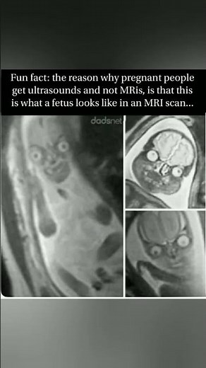 👶🧲MRI BABY looks like a sci‑fi ALIEN 👽✨ That’s why ULTRASOUND rules the womb 🌌💥 #MindBlown