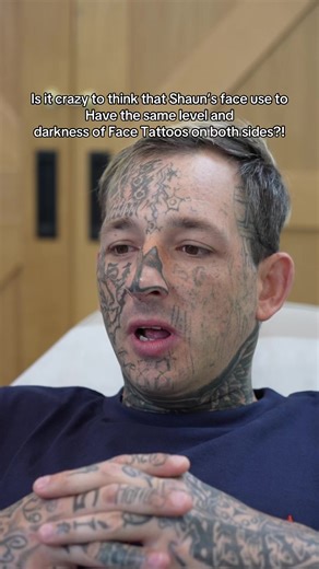 Shaun's Face Tattoo Removal Journey Explained