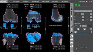 Achieving Functional Knee Positioning™ with Mako Total Knee 2.0 and Triathlon® Cementless