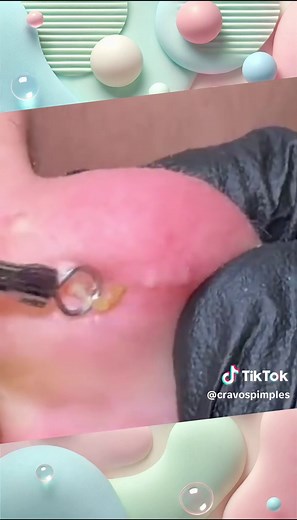 Ear pimple #earpimple #foryou #foryoupage #viralvideos