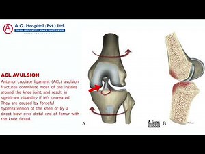 ACL AVULSION INJURY