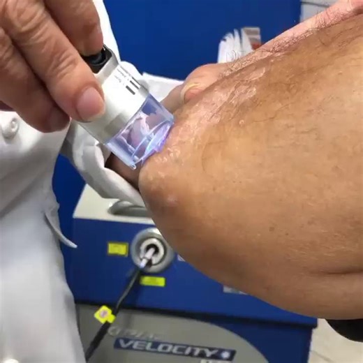 Seeing is believing 💡 Our partners at Khouri Dermatology are achieving amazing results using XTRAC® laser therapy to help patients manage psoriasis flare-ups and regain confidence in their skin. No downtime. Real results. Clearer skin. 🙌 #XTRAC #XTRACclear #XTRACtreatment #PsoriasisRelief #PsoriasisCare #ExcimerLaser #LightTherapy #ClearSkin #Dermatology #SkinHealth #PsoriasisAwareness #repost | XTRAC Psoriasis, Vitiligo, and Atopic Dermatitis Treatment