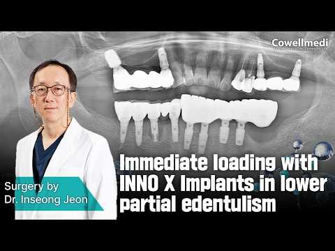 Immediate loading with INNO X Implants in lower partial edentulism