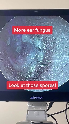 Ear fungus (otomycosis). #earinfection #earwaxremoval #ent #lastofus