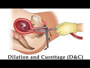 Dilation and Curettage D&C ; surgical procedure to remove tissue from inside the uterus