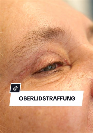 Oberlidstraffung: Fäden Entfernen Nach Der OP