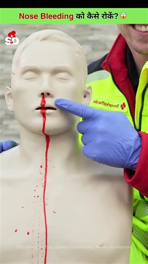 First Aid for Nose Bleeds: Effective Steps to Follow