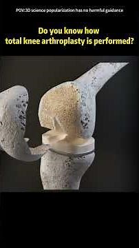Total knee replacement (3D Animation)#totalkneereplacement #kneereplacement #3danimation