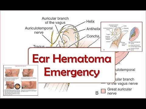Ear Hematoma Emergency
