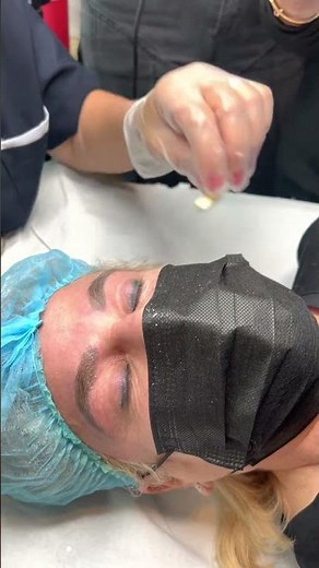 Microblading Removal with Magnetic Tattoo Removal Technique