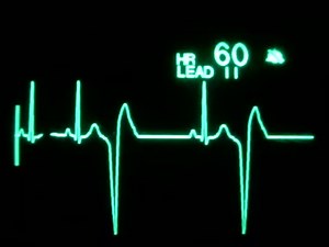 Bigeminal PVCs #CCU_RHYTHM | CCU