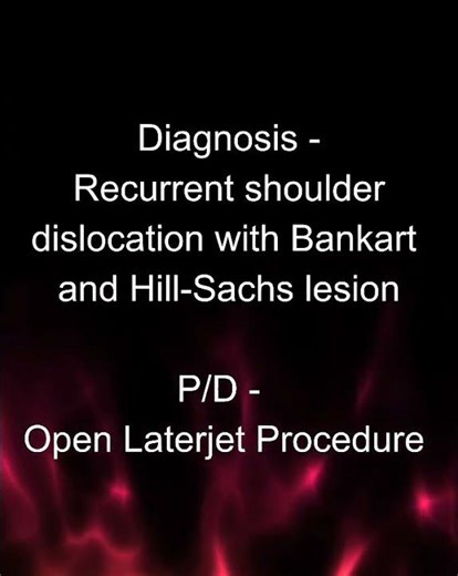 Ortho shoulder surgery- recurrent shoulder dislocation