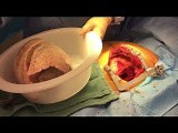 Unilateral Lung Transplantation with Antrolateral Thoracotomy • Video • MEDtube.net