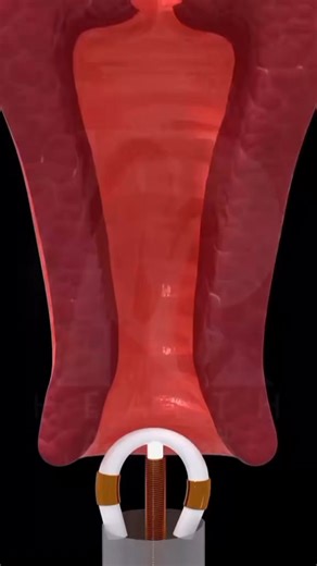 Was this IUCD properly inserted? #famiyplanning #contraception | Fellow Nurses