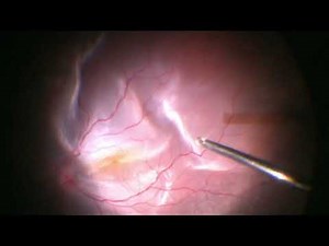 Vitrectomy for Retinal detachment with subretinal band removal | RD | Dr Manish Nagpal