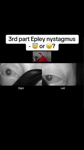 Orthotropic (right torsion upbeat) nystagmus in 3rd part of modified Epley = likely success #bppv
