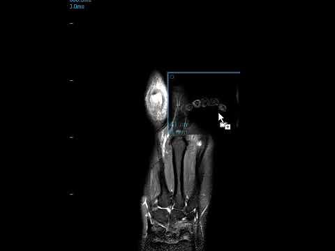 Central slip tear finger