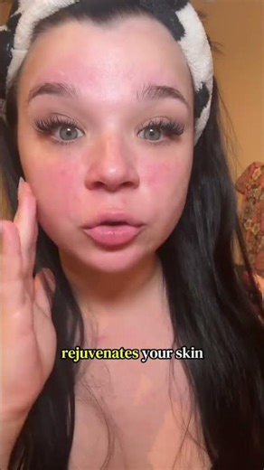Hydrate your skin like your 21 with the EGF blue serum #acnescars #acnescartreatment #egf