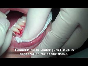 Gingival Graft  • Video • MEDtube.net