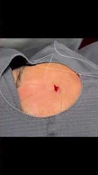 Can We Get This Forehead Steatocystoma?