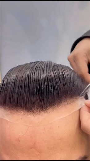 hair patch on Instagram: ""Life-Changing Hair Patch Result – Before vs After!" #hairwig #hairpatch #trendingreels #hairreplacement #bigbesthairfixingg #hairextension #viralreels #hairfixingcenter"