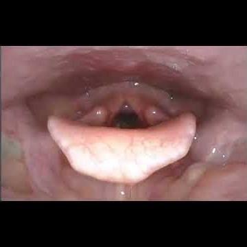 Olympus CV-170 HD and Video Rhino-Laryngoscope Paired with TIMS MVP