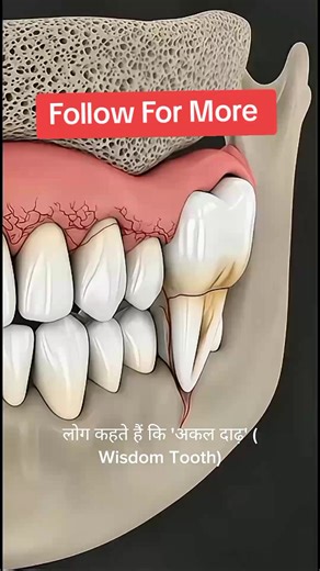 Aqal Daadh aane par dard kyun hota hai? 🦷😫 (Sach Janiye) #wisdomtooth #aqaldaadh #dentist #teeth #medical