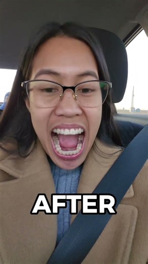 Invisalign treatment before and after