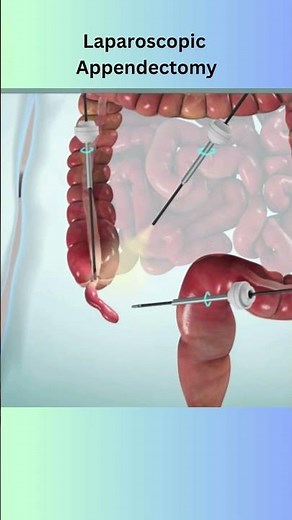 Appendectomy medical animation #medicaleducation #anatomy #surgerysimulator
