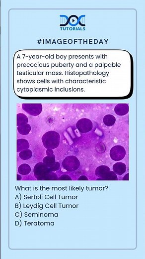 What is the most likely tumor?