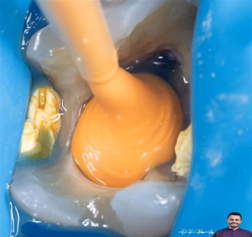 Dr Mostafa Askarya on Instagram: "Endo Retreatment & emax onlay cuspal coverage full story with Al twist"