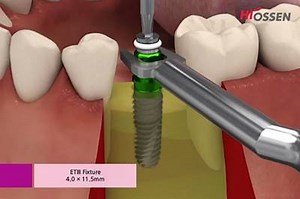 Secuencia de fresado, sencilla y segura para implante #ETIIISA con #TaperKit de #Hiossen by #Osstem #Implants | Osstem Miguel
