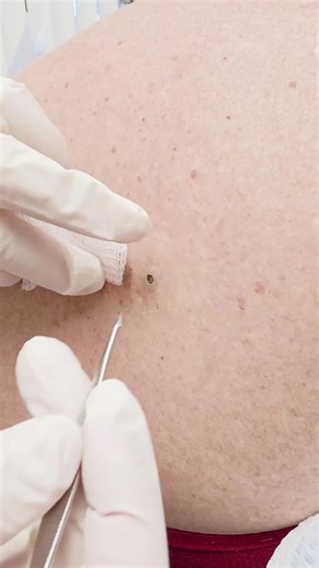 Dr. Olga Goulko's Milia Removal Treatment ⁣⁣⁣ ⁣⁣Dermatology & Laser Surgery Center⁣⁣⁣⁣⁣⁣ ✉️- info@lasersurgery.net⁣⁣⁣⁣⁣⁣ 🖥- www.lasersurgery.net⁣⁣⁣⁣⁣⁣ 🏢- 2125 Center Ave⁣⁣⁣, Fort Lee, NJ⁣⁣⁣ ☎- 201-461-5655⁣ ⁣⁣⁣⁣⁣⁣ ⁣⁣⁣⁣⁣ #acne #adultacne #drolgagoulko #milia #miliaremoval