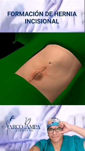 Understanding Hernia Incisional Surgery