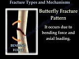 Working Bones Fractures, Types And Mechanisms  • Video • MEDtube.net