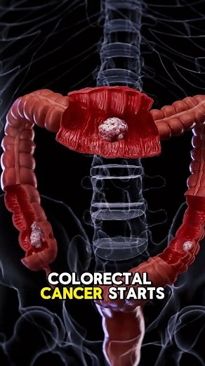 Colorectal Cancer Surgery Explained (3D Animation) #colorectalcancer #Cancer #ColorectalHealth #Surgery #ColorectalCancerScreening #colorectalcancersurvivor #colorectalsurgery #Explained #colorectalcancerawareness #surgeon #painrelief #asleep #often #healing #affect #AIMS #medical3danimation #3dmedicalanimation | Medcare777