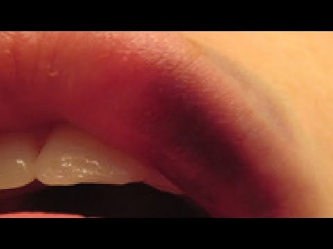 how to get rid of bruises on your lips fast and easy