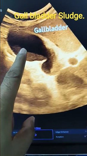 Gall bladder sludge in ultrasound views. #ultrasound #anatomy #gallbladder #liver #sludge