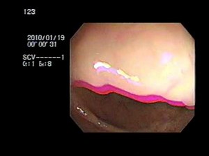 Under 2 minutes Total Colonoscopy