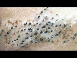 One Spa Time Acne Treatment 015