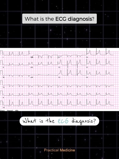 Understanding ECG Diagnosis for Chest Pain