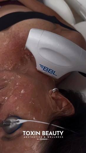 12 reactions | BBL (BroadBand Light): • Evens skin tone and...