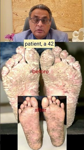 Psoriasis on Feet Soles: Incredible Before & After Homeopathy Treatment Results!